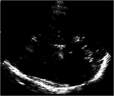 Frontiers Bedsided Transcranial Sonographic Monitoring For Expansion And Progression Of